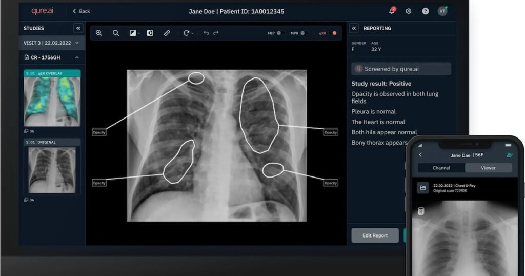 Qure.ai pursuing large AI with M Series D funding and more briefs