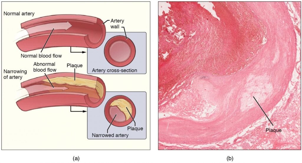 Clinical trial finds RNA inhibitor effectively reduces ‘bad cholesterol’ in patients with cardiovascular disease