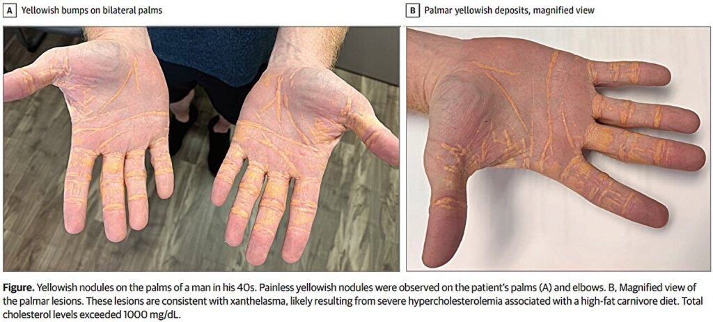 Man on carnivore diet develops yellowish nodules on his hands, feet and elbows