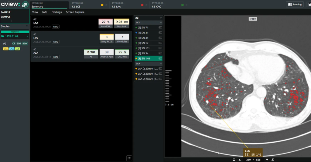 Coreline Soft’s lung cancer screening AI added to Bayer’s Calantic platform