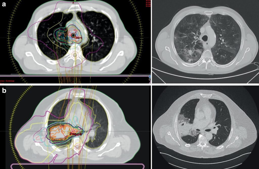 High-dose radiotherapy can be safe and promising for lung cancer in combination with immunotherapy