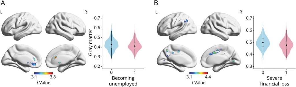 Death of a partner and financial stress linked to increased risk of Alzheimer’s disease, differences in brain structure