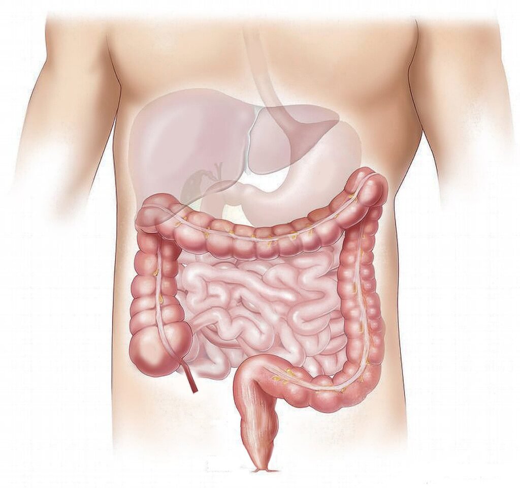 Healthy lifestyle linked to lower diverticulitis risk, irrespective of genetic susceptibility