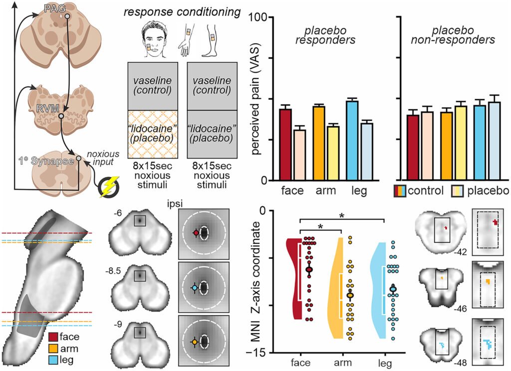 Placebo pain relief works differently across the human body, study finds