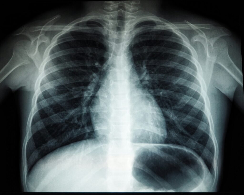 Digital health outreach can improve lung cancer screening