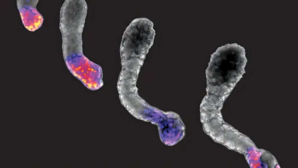 Gene mutation linked to cancer may also cause spine problems, study reveals