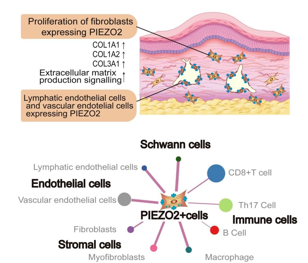 Researchers discover a type of fibroblast that may contribute to the formation and recurrence of overgrown scars